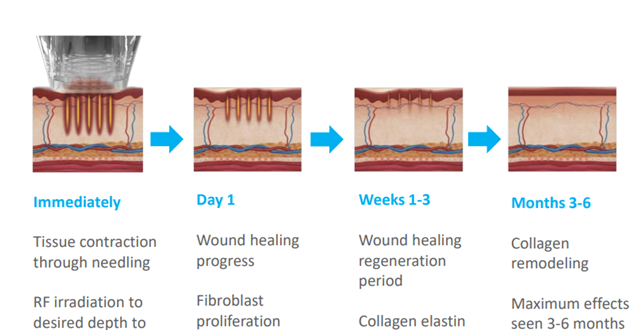 RF microneedling process