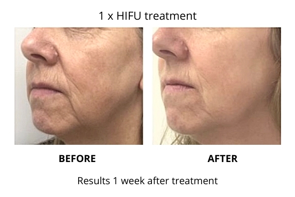 HIFU anti ageing skin treatment results