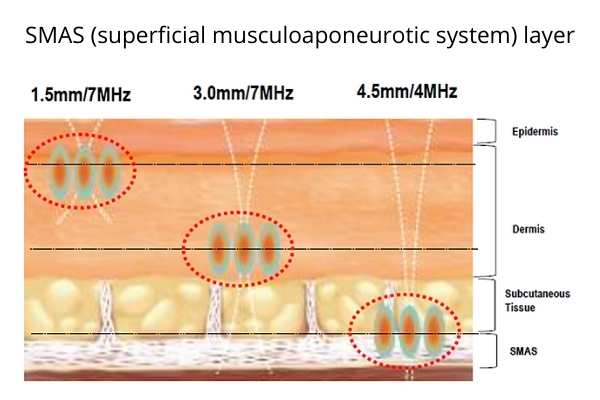 HIFU treatment SMAS skin layers