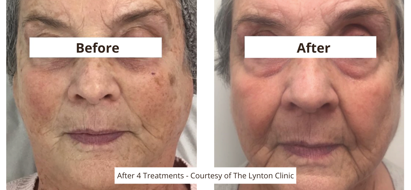 IPL Facial IPL Facial