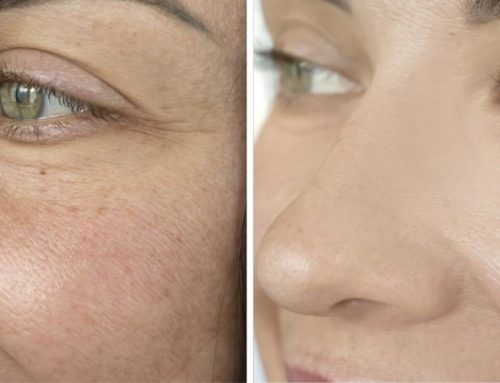 What is an IllumiFacial and how does it work?
