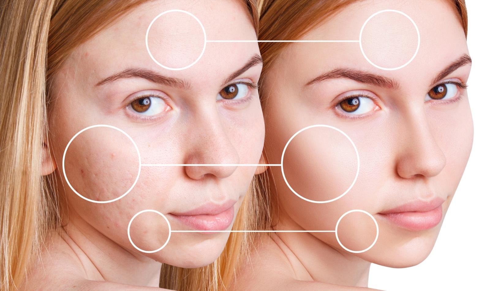 acne treatment basingstoke