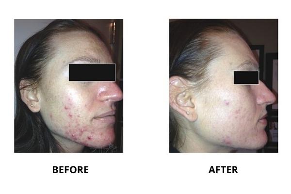acne treatment basingstoke
