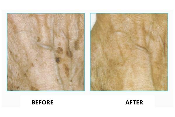 IPL skin pigmentation treatment