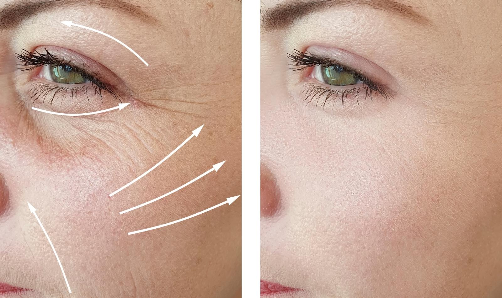 Example effects that can be acheived -microneedling with radiofrequency before and after