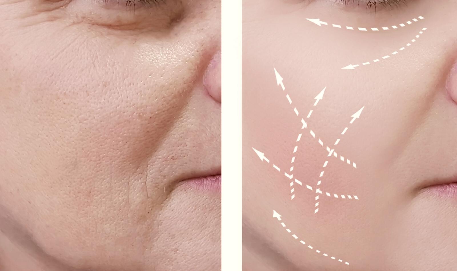 RF microneedling face skin target areas