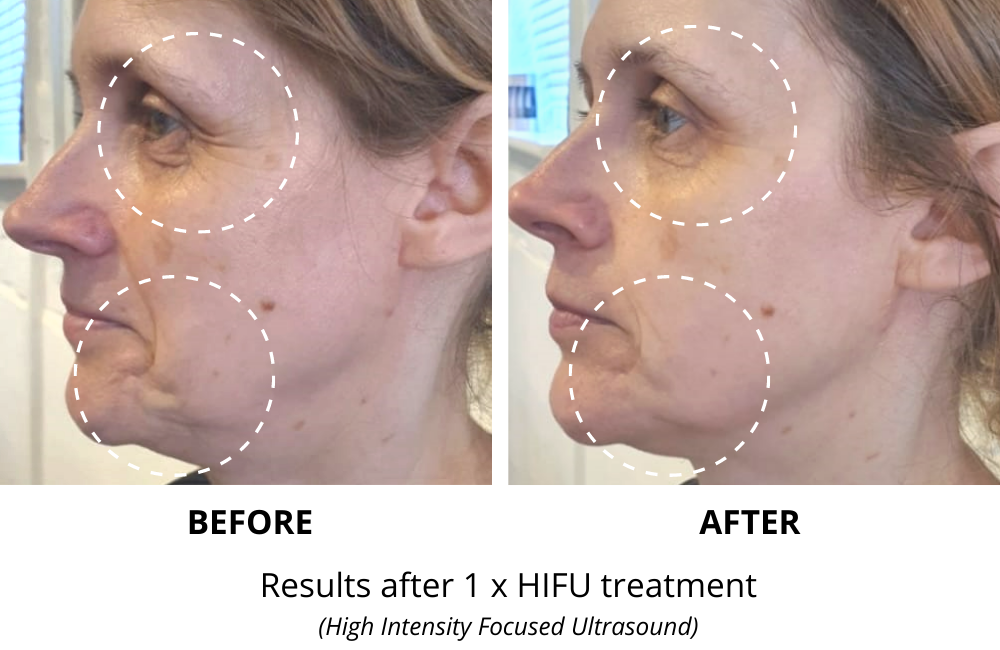 HIFU Body Sculpting Treatment - Hampshire