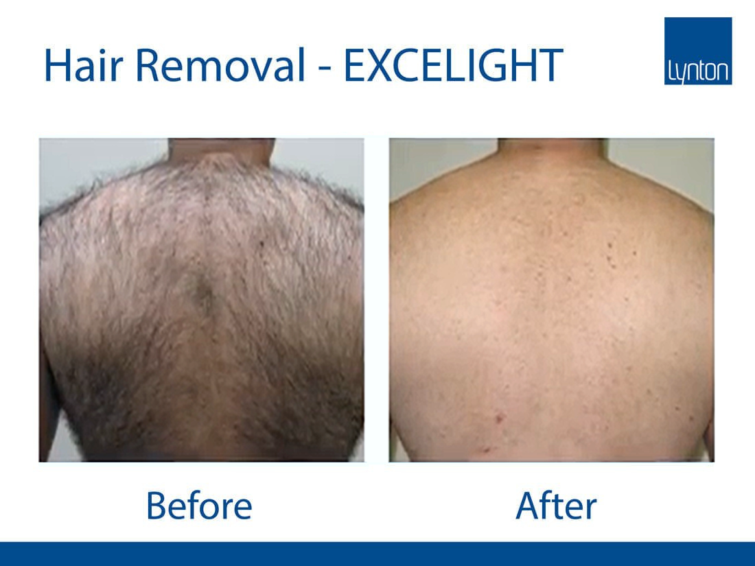 IPL back hair removal basingstoke