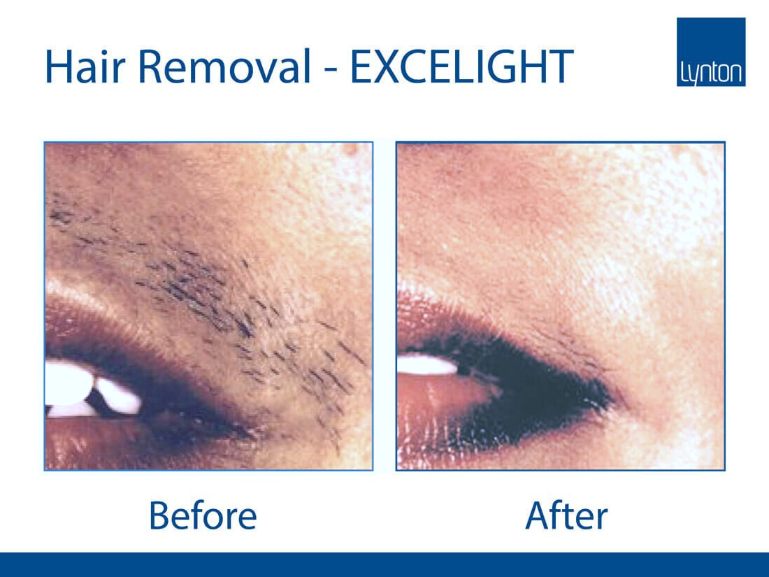 laser clinics basingstoke - IPL lip hair removal
