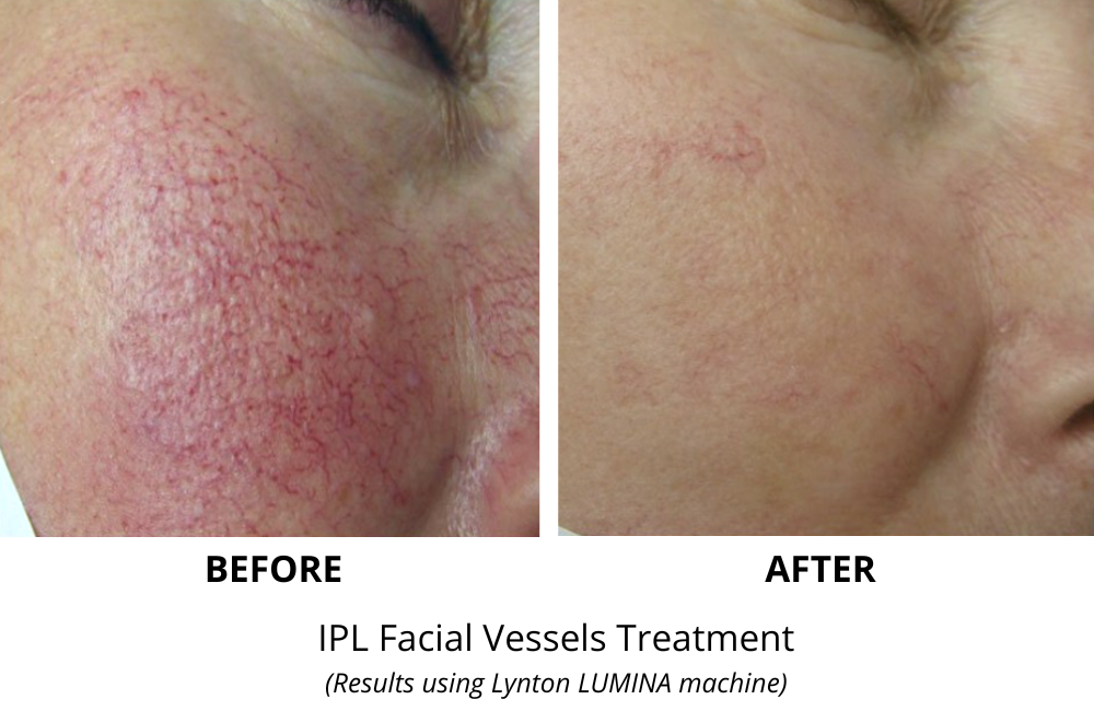 Facial thread vein removal