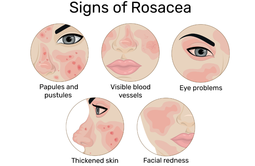 IPL rosacea treatment