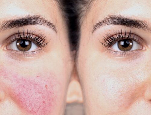 What is the best rosacea and thread vein removal treatment?