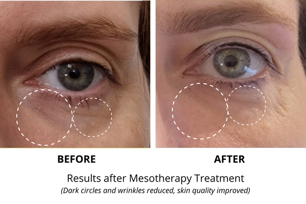 Mesotherapy eye treatment