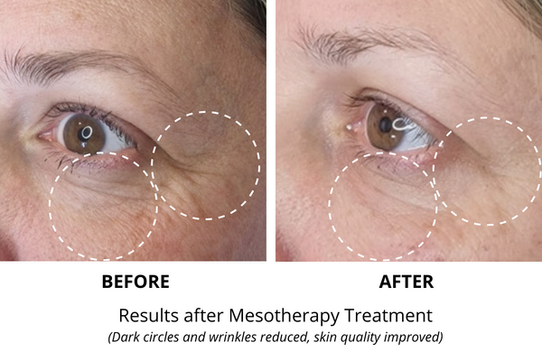 Mesotherapy facial