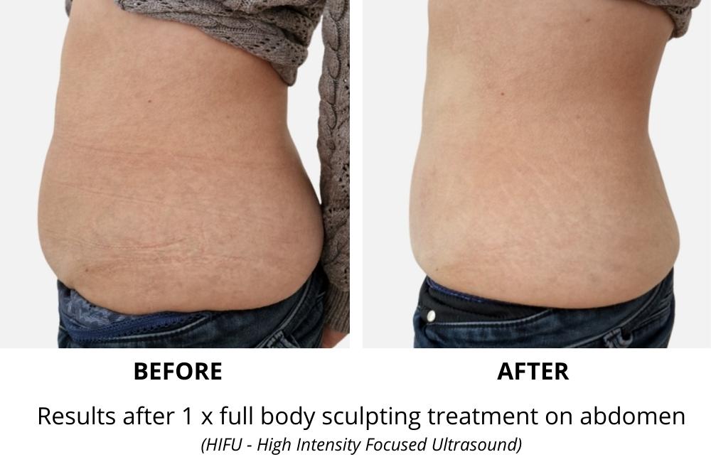 What is body sculpting? Does body sculpting work?