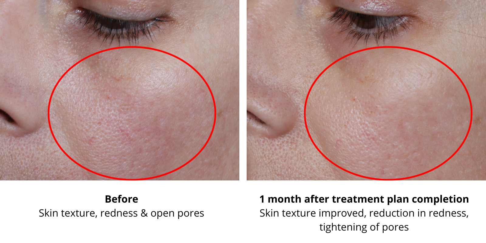 skin rejuvenation treatment Hampshire - reduction in skin redness and open pores