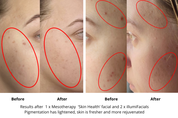 aesthetic facial treatment - before and after
