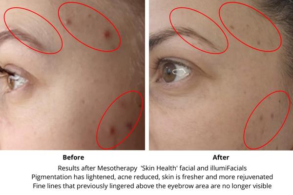 advanced facial aesthetics treatments - before and after