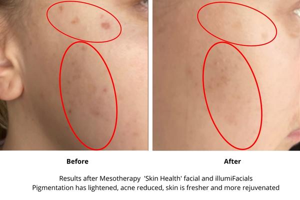 illumiFacial and mesotherapy facial treatment - before and after