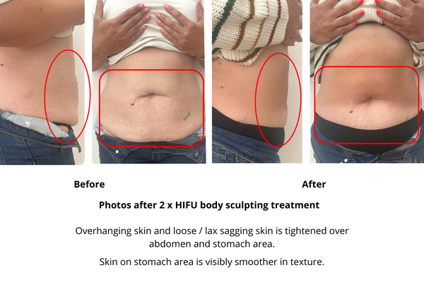 HIFU body sculpting before and after photos