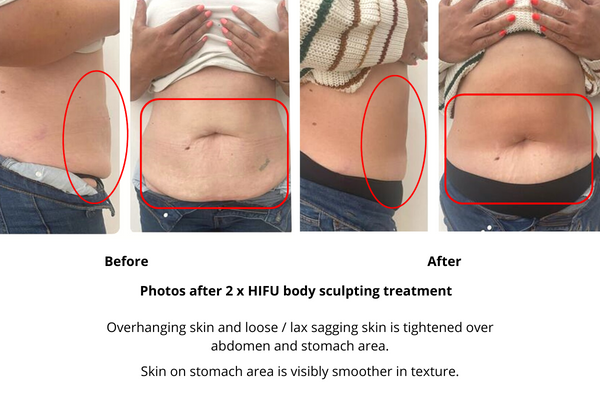 HIFU Body Sculpting Treatment - Hampshire