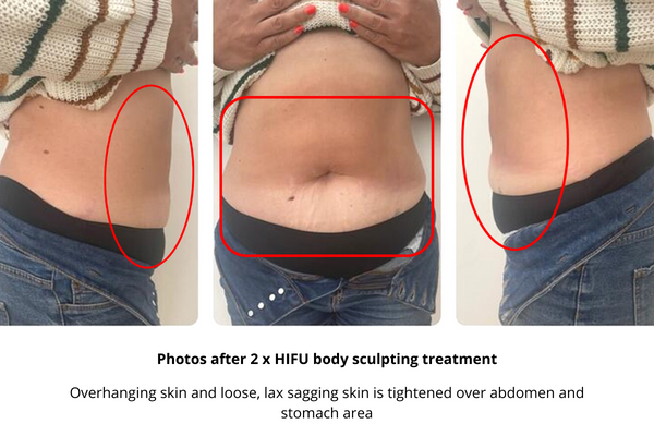 HIFU body sculpting photos after 2 treatments