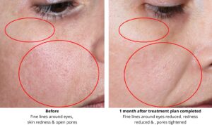 skin rejuvenation treatment Basingstoke Hampshire