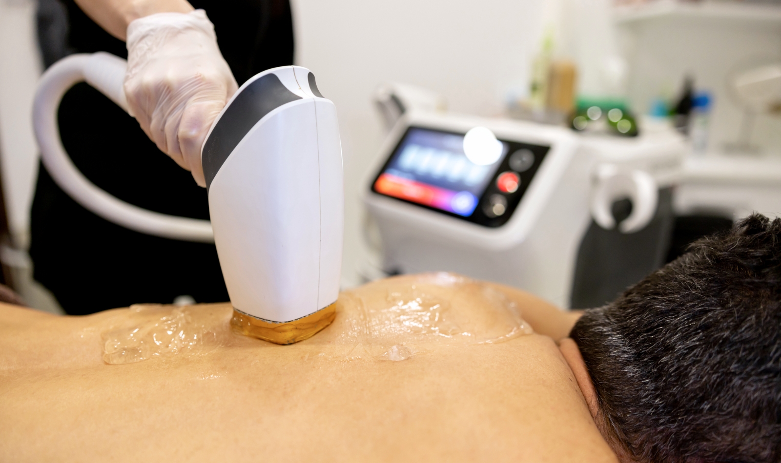 IPL back hair removal case study